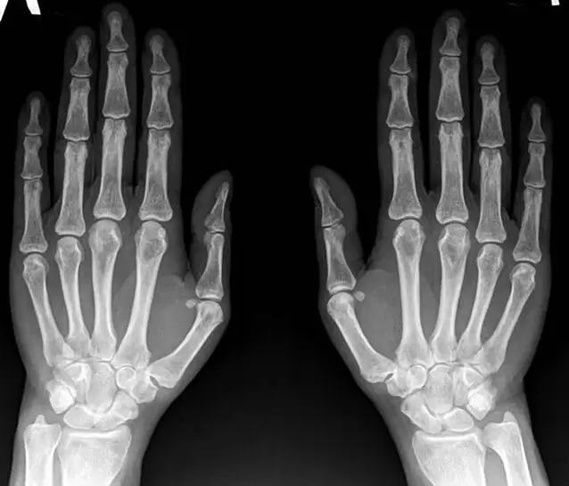 arthritis of the wrist joint on x-ray before Hondroine