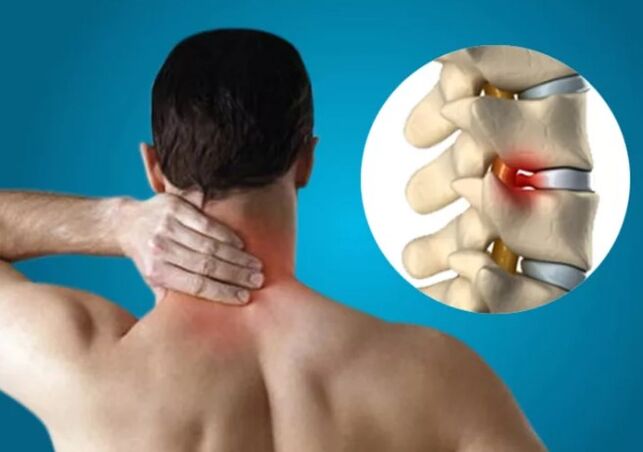 Cervix osteochondrosis