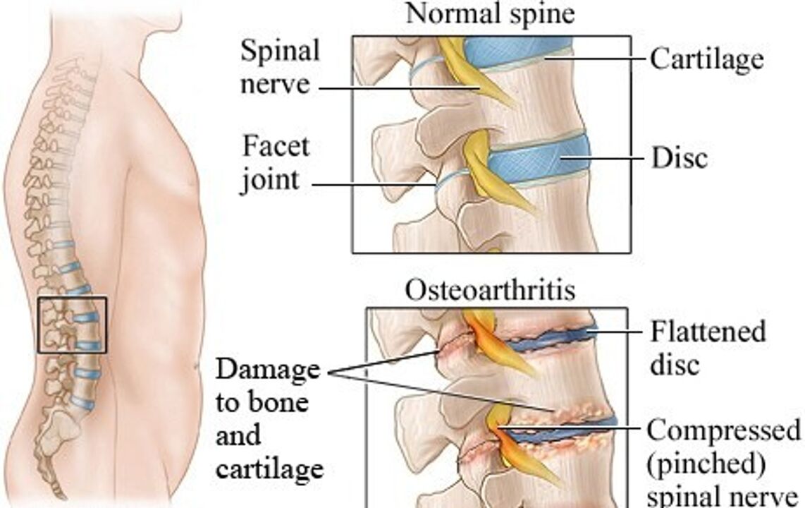 The difference between a healthy disc and a disk with osteochondrosis