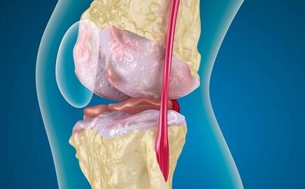 Causes of the formation of arthrosis of the knee joint