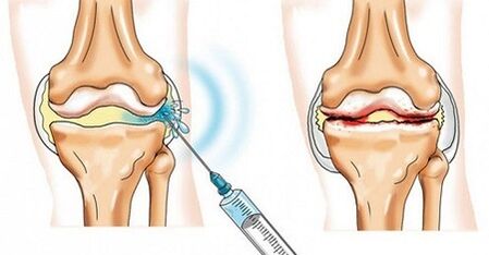How to treat the knee joint arthrosis